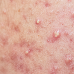 Active Acne