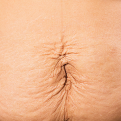 Belly Skin Laxity