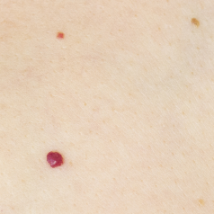 Vascular Lesions