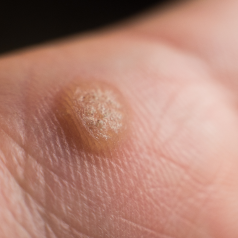 Wart on body
