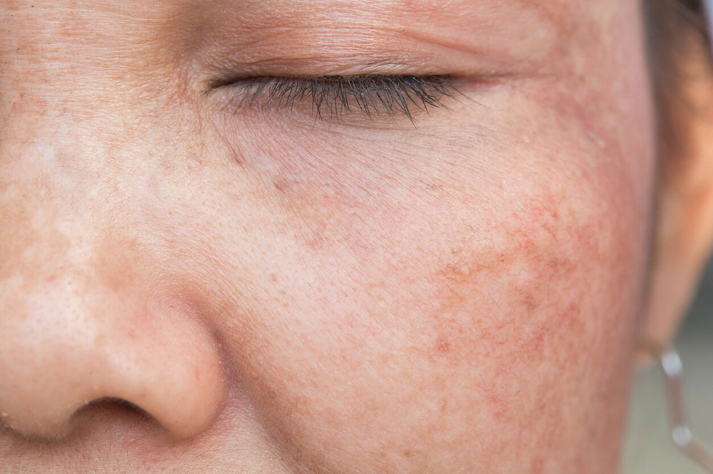 sun damaged skin