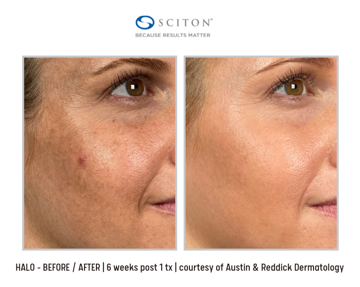 Halo laser treatment before and after photos - 6 weeks after 1 treatment
