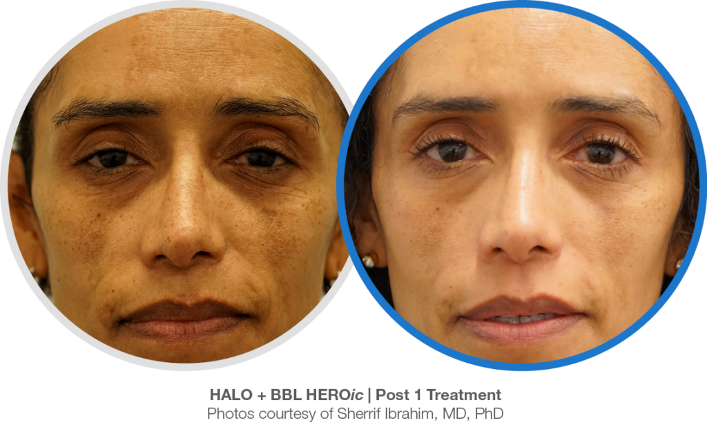 HALO and BBL HEROic before and after image.