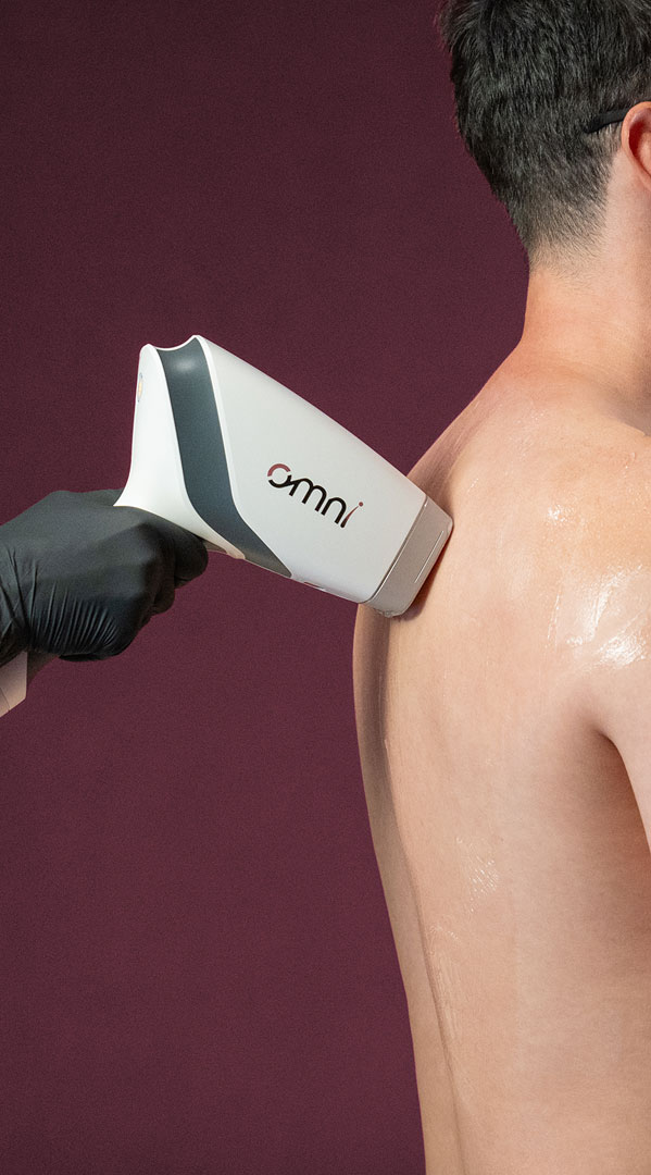 Sciton OMNI hair removal system handpiece removing hair from a man's back
